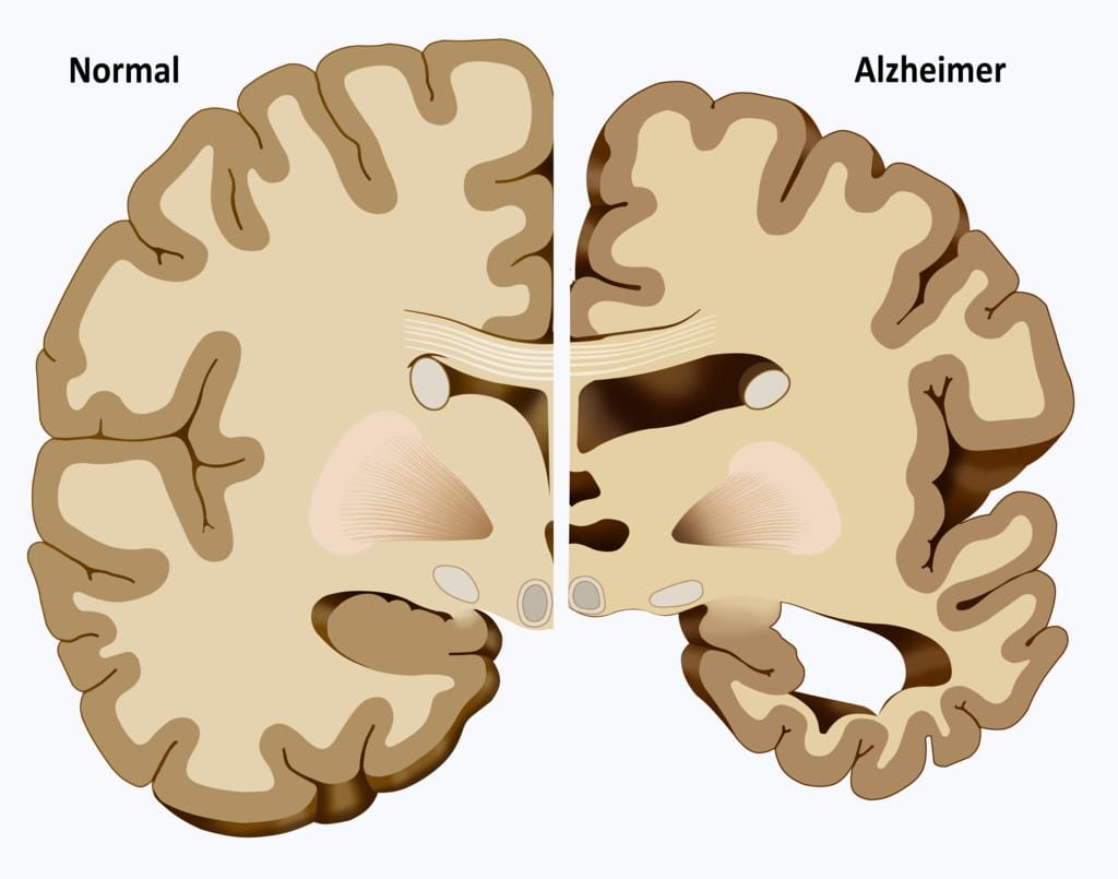 Tratamento Natural para Alzheimer