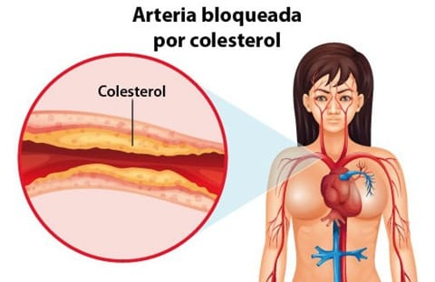colesterol elevado sintomas tratamentos e causas 2