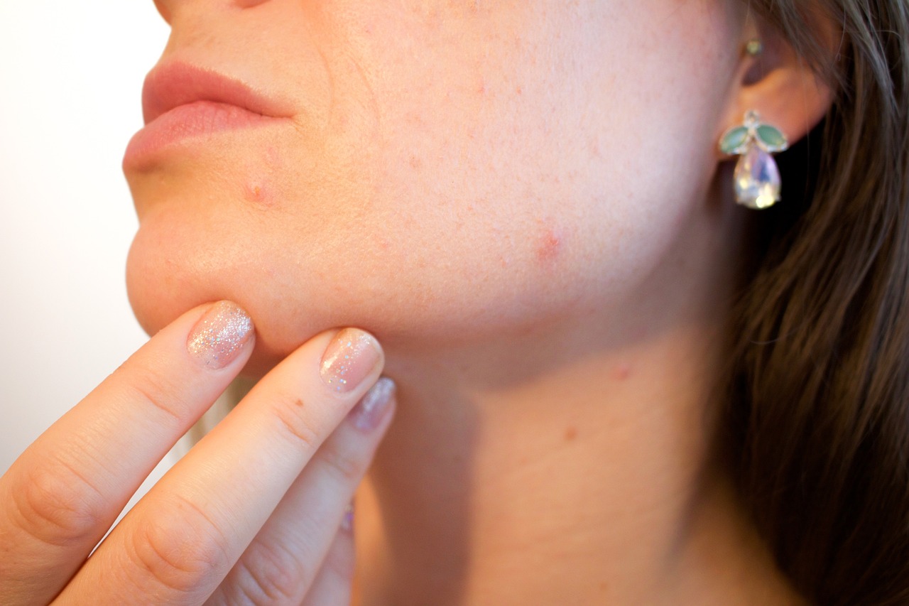 As causas da acne e tratamento
